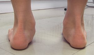Overpronation